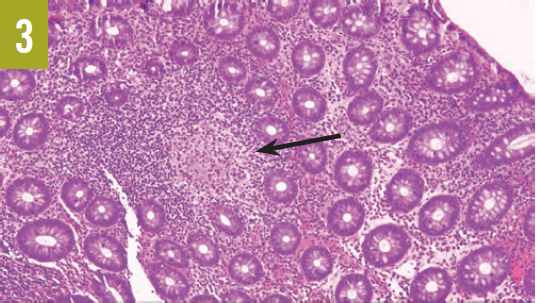 Histopathology results of biopsy