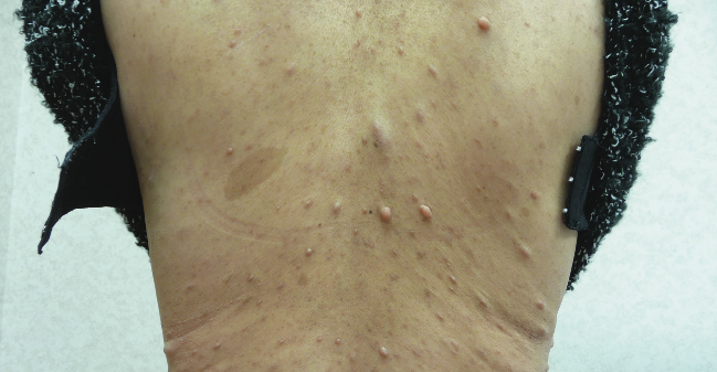 Neurofibromatosis Type 1