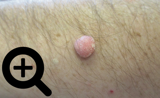 nevus lipomatosus superficialis