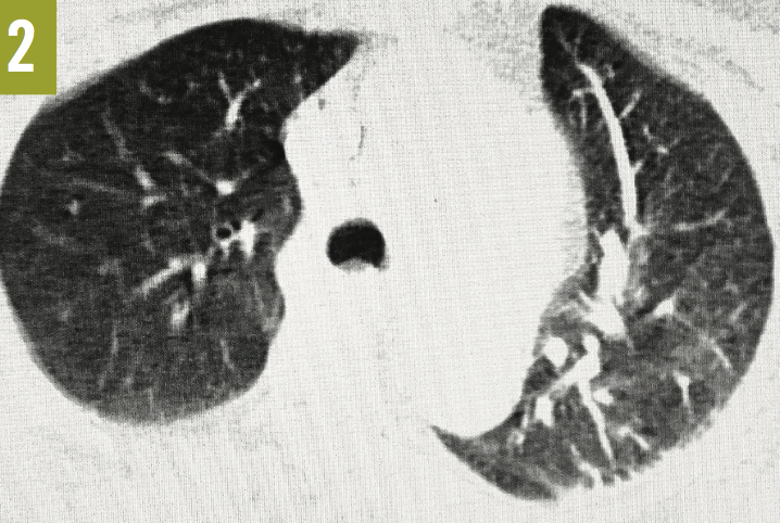Pulmonary Embolus
