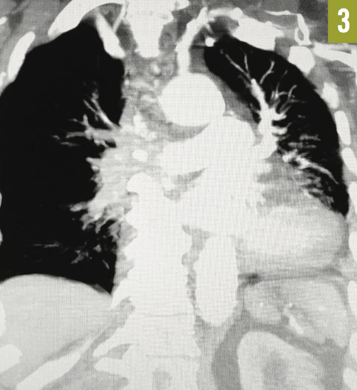 Pulmonary Embolus