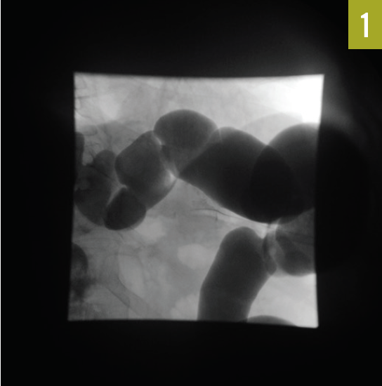 Limited barium enema