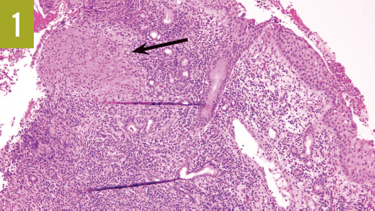 nonnecrotizing granuloma