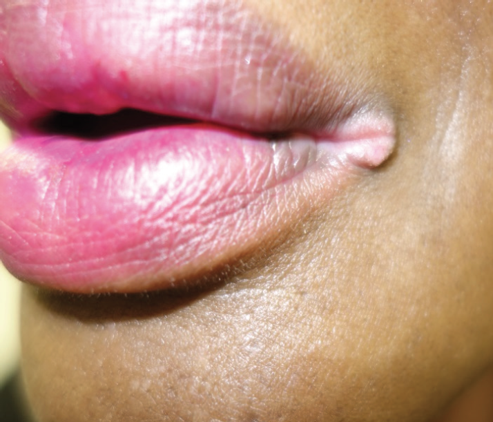 split pea papule syphilis