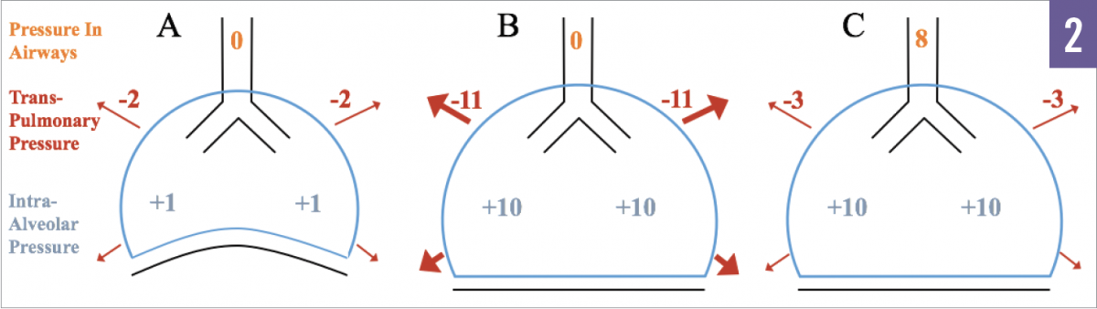 Pitfalls in the Initial Management of Mechanical Ventilation Figure 2