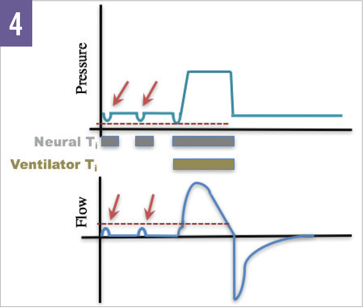 Pitfalls in the Initial Management of Mechanical Ventilation Figure 4