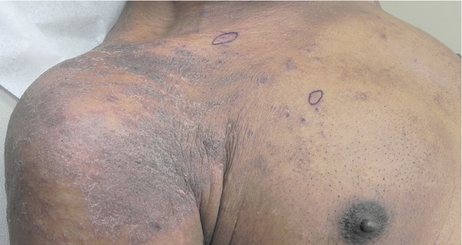 Scabies figure 1