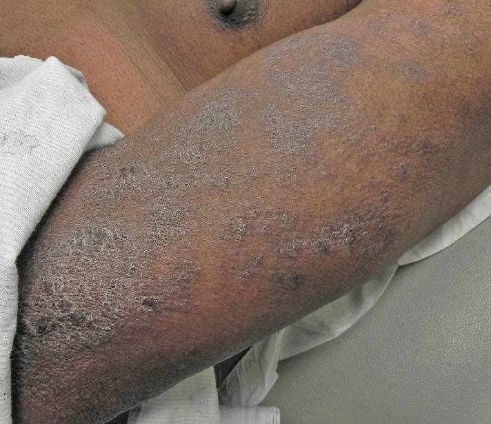 Scabies figure 3