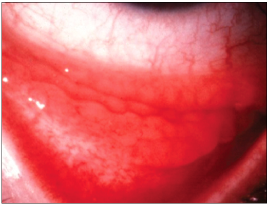 herpes simplex herpes simplex