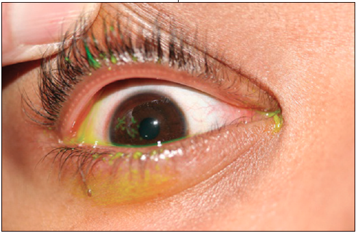 epithelia keratitis epithelia keratitis