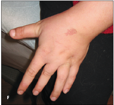 incontinentia pigmenti