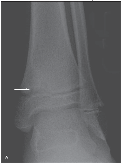 ankle X-ray 
