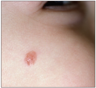 Spitz nevus