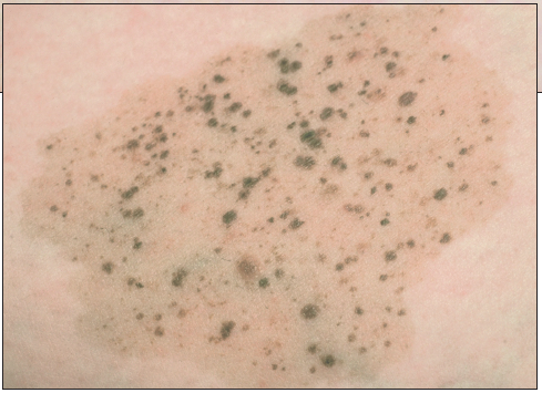 speckled lentiginous nevus