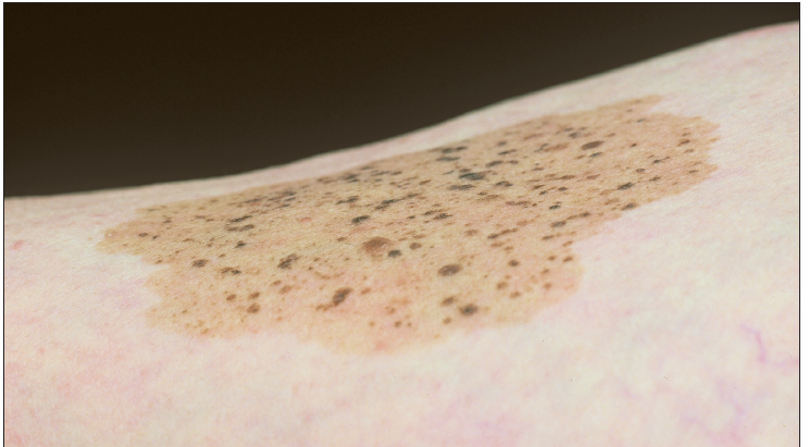 speckled lentiginous nevus