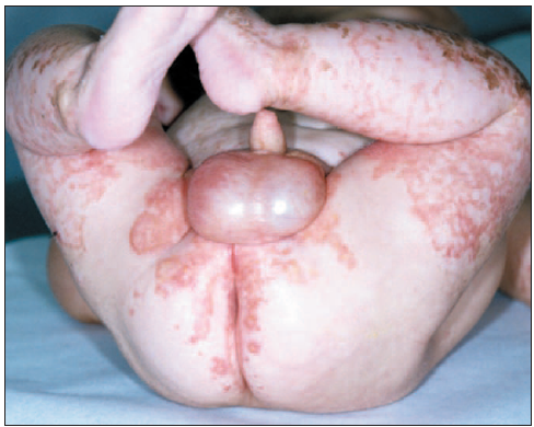 Acrodermatitis enteropathica