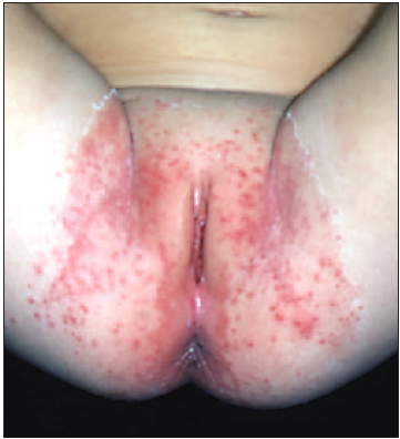 Psoriasis with pustules (Candida)