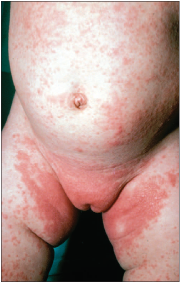 Atopic eczema