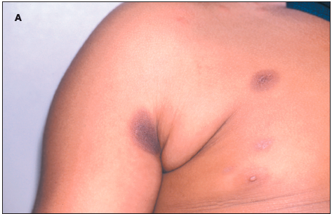 hyperpigmented areas