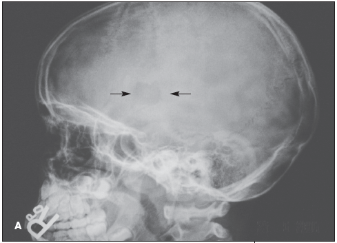 Eosinophilic Granuloma