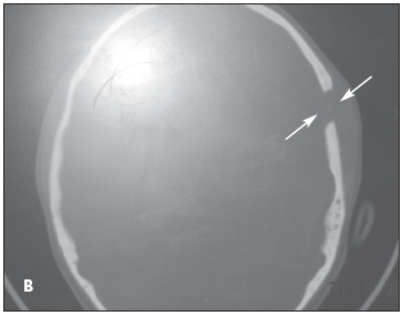 Eosinophilic Granuloma