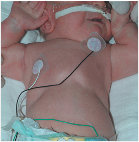 Ellis-van Creveld (EVC) syndrome