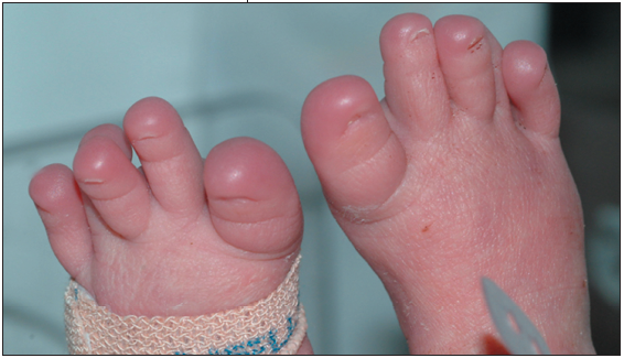 Ellis-van Creveld (EVC) syndrome