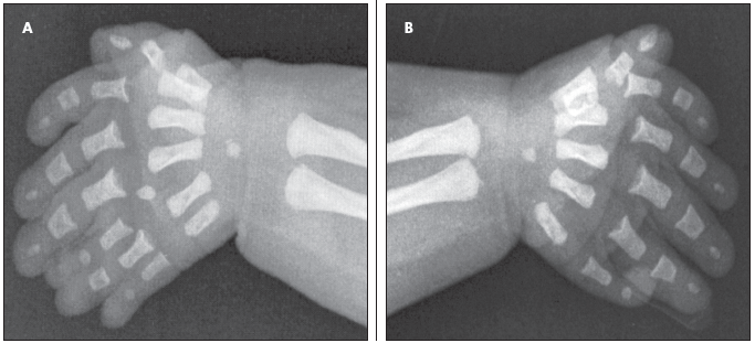 Ellis-van Creveld (EVC) syndrome