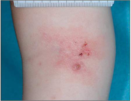 molluscum contagiosum