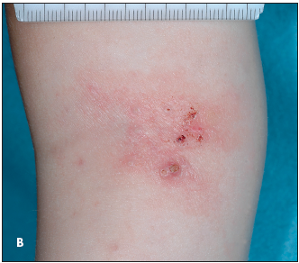 Molluscum contagiosum