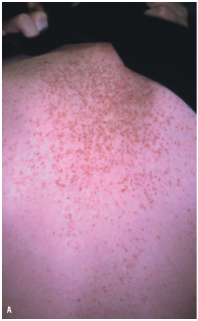 Darier-White Disease