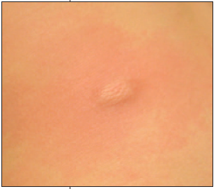 solitary nodule with a positive darier sign