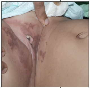 child with bullous legion on groin