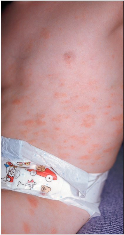annular lesions