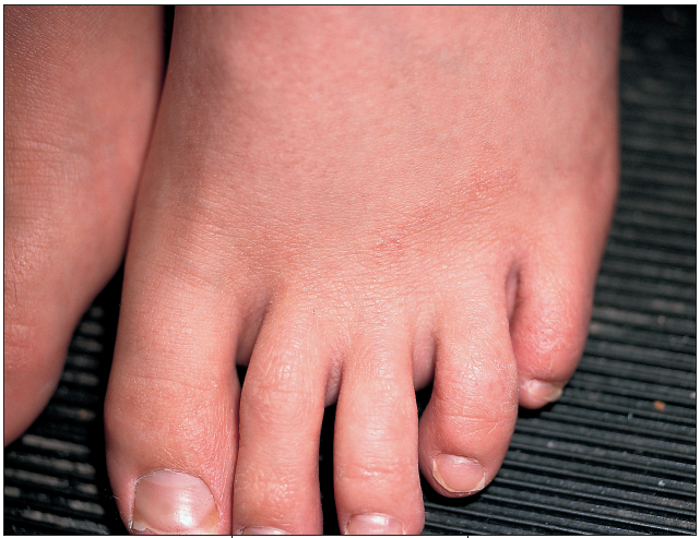 rash on foot