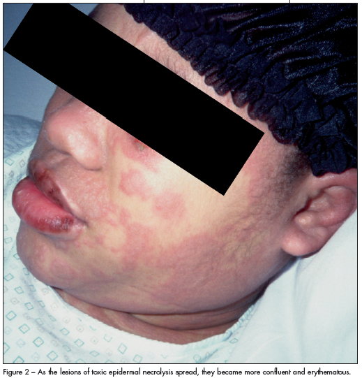 lesions of epidermal necrolysis