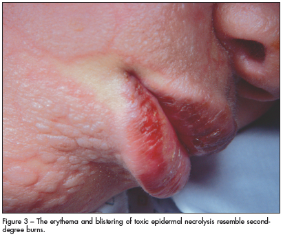 erythema and blistering