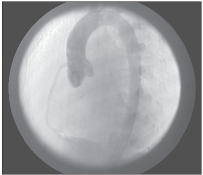 angiographic injection