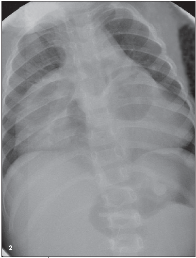 diaphragmatic hernia
