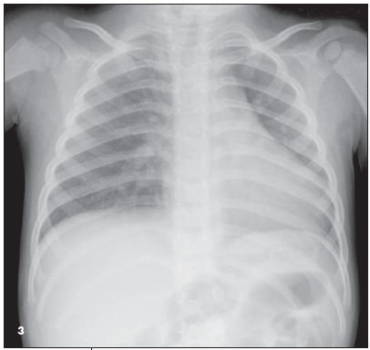 diaphragmatic hernia
