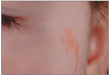 nevus sebaceous of jadassohn