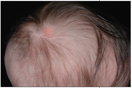 nevus sebaceus on scalp