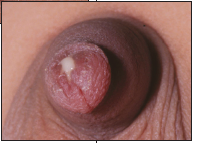 acute balanoposthitis