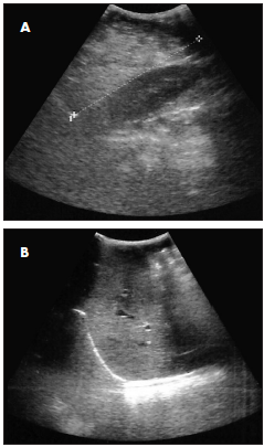 ten induced cholestasis