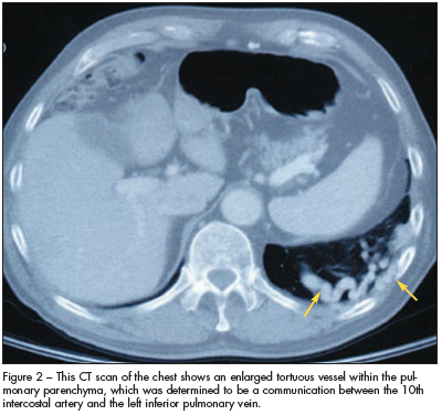 ct scan of the chest