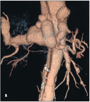 Hepatic Artery Aneurysm