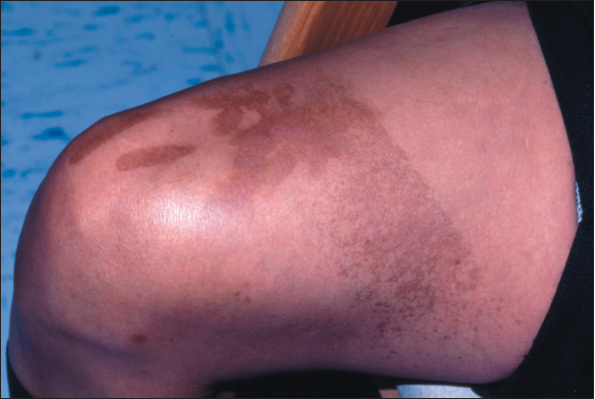 Unusual Pigmentation Pattern