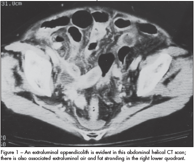 abdominal CT scan