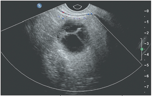 cystic mass
