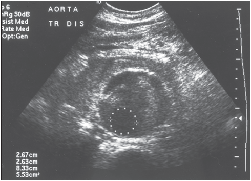 aortic aneurysm